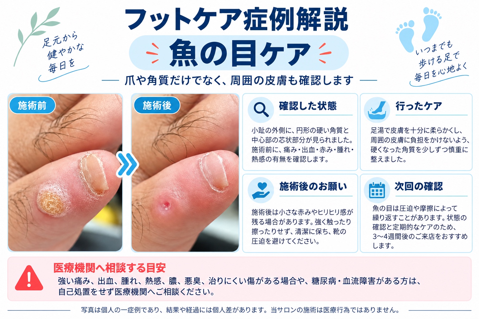 魚の目ケアの症例解説。施術前後の足裏の写真とケアの説明